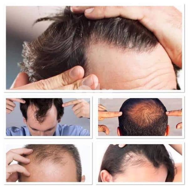 forever hair loss products - Mobile Phones - 104587972
